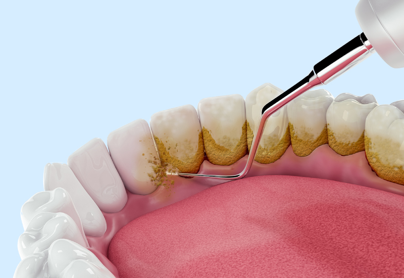 Гигиена полости рта