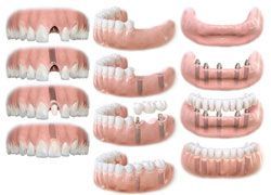 Разновидности зубных имплантатов