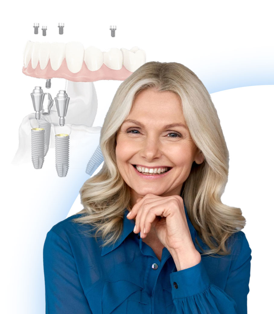 Протезирование на имплантах All-on-4 и All-on-6